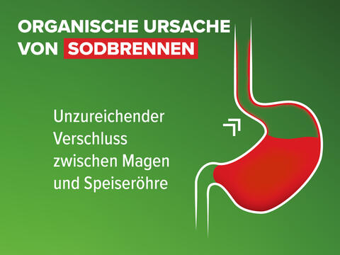 Schaubild: Organische Ursache von Sodbrennen durch unzureichenden Verschluss zwischen Magen und Speiseröhre. Die Magensäure kann nach oben steigen.