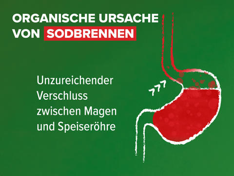 Schaubild: Organische Ursache von Sodbrennen durch unzureichenden Verschluss zwischen Magen und Speiseröhre. Die Magensäure kann nach oben steigen.