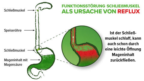 Grafik Ursache von Reflux