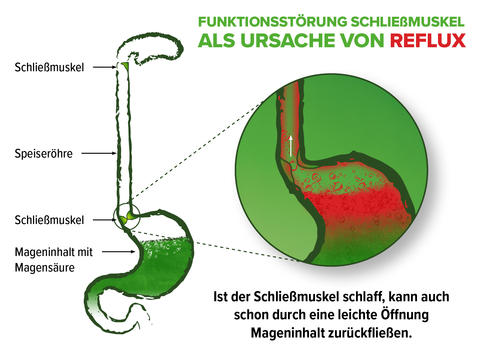 Schaubild: Funktionsstörung des Schließmuskels als Ursache von Reflux